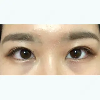 56日目の経過画像（1枚目）