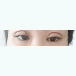 1日目の経過画像（1枚目）