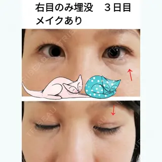 3日目の経過画像（1枚目）