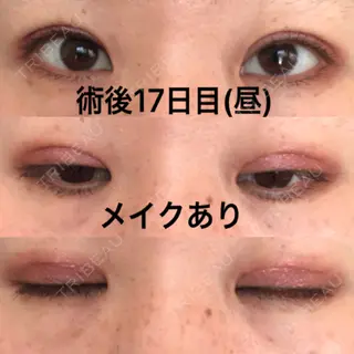 17日目の経過画像（1枚目）