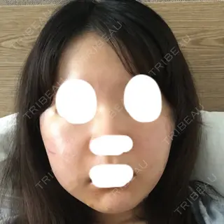 1日目の経過画像（2枚目）