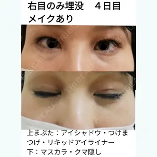 4日目の経過画像（2枚目）