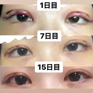 15日目の経過画像（3枚目）