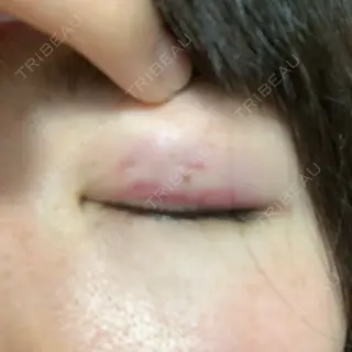 1日目の経過画像（2枚目）