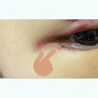 2日目の経過画像（3枚目）