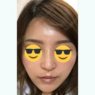19日目の経過画像（3枚目）