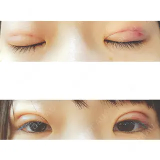 1日目の経過画像（1枚目）