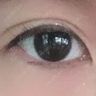 156日目の経過画像（1枚目）