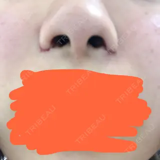 0日目の経過画像（1枚目）