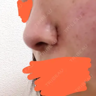 0日目の経過画像（2枚目）