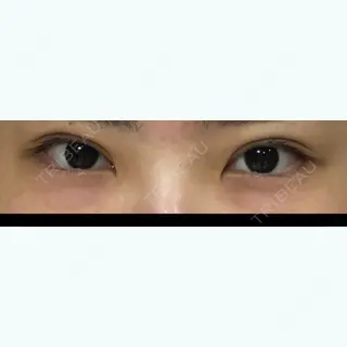 177日目の経過画像（1枚目）