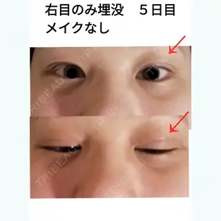 5日目の経過画像（1枚目）