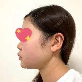 6日目の経過画像（3枚目）