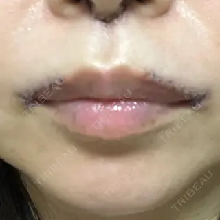 7日目の経過画像（1枚目）
