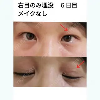 6日目の経過画像（1枚目）
