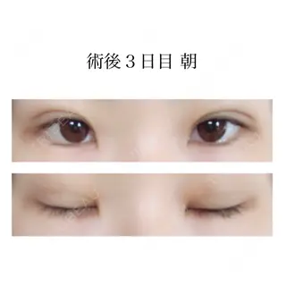 3日目の経過画像（1枚目）