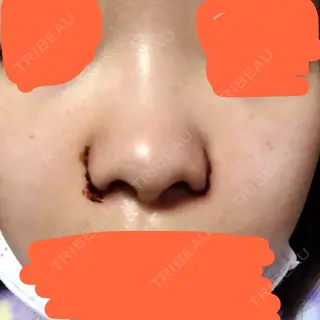 2日目の経過画像（1枚目）