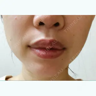 5日目の経過画像（1枚目）