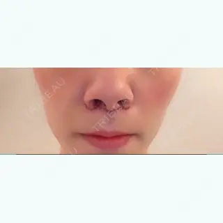 3日目の経過画像（1枚目）