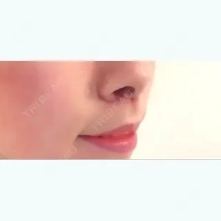 7日目の経過画像（2枚目）