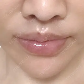 11日目の経過画像（1枚目）