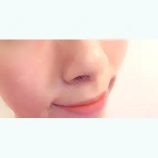 9日目の経過画像（1枚目）