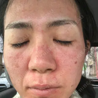0日目の経過画像（1枚目）
