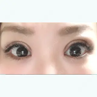 30日目の経過画像（3枚目）