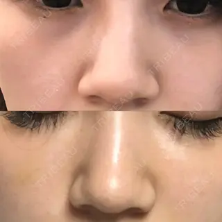 6日目の経過画像（1枚目）