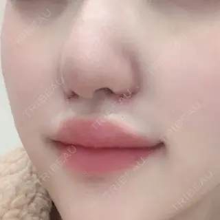 6日目の経過画像（1枚目）