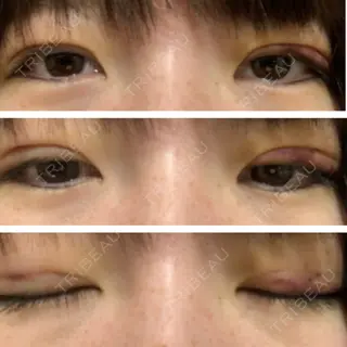 4日目の経過画像（1枚目）