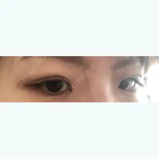 4日目の経過画像（3枚目）