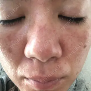 2日目の経過画像（2枚目）