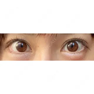 33日目の経過画像（1枚目）