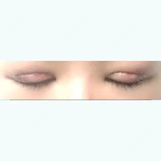 1日目の経過画像（2枚目）