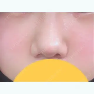 7日目の経過画像（1枚目）