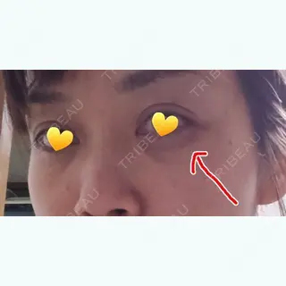 9日目の経過画像（2枚目）