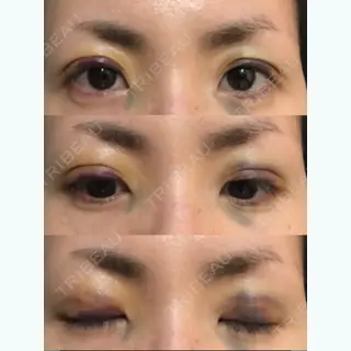 3日目の経過画像（2枚目）