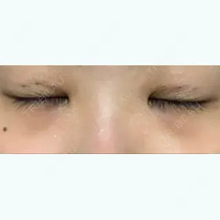 3日目の経過画像（3枚目）