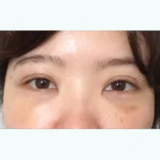 5日目の経過画像（1枚目）