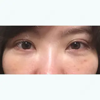 6日目の経過画像（1枚目）