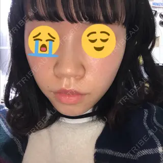 6日目の経過画像（1枚目）
