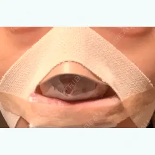 0日目の経過画像（1枚目）
