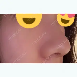 7日目の経過画像（2枚目）