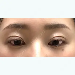 92日目の経過画像（3枚目）