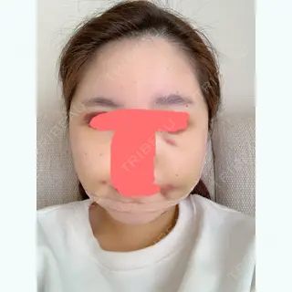 9日目の経過画像（1枚目）