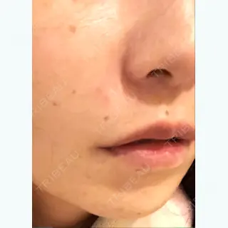 245日目の経過画像（1枚目）