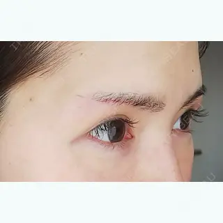 37日目の経過画像（2枚目）