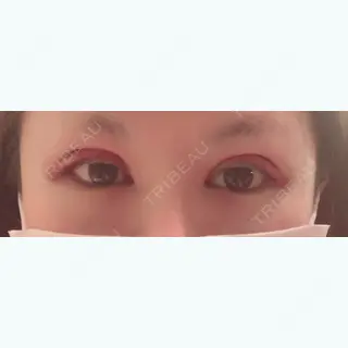 1日目の経過画像（1枚目）