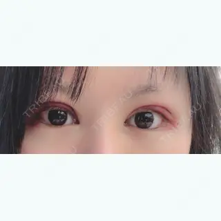 2日目の経過画像（1枚目）